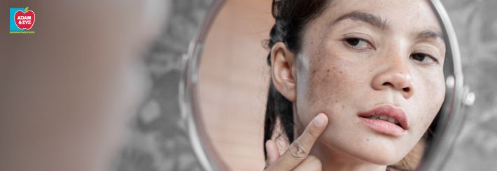 Melasma: Diagnosis and treatment