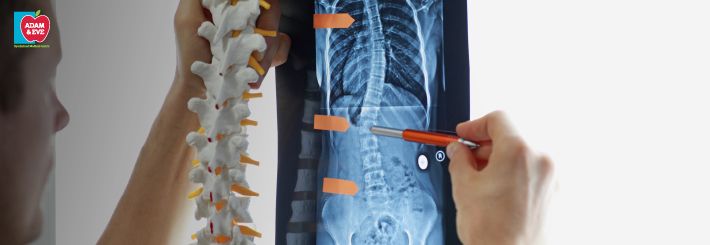 Scoliosis – Symptoms, Diagnosis, and Treatment