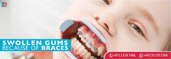 Braces and Other Causes of Swollen Gums 